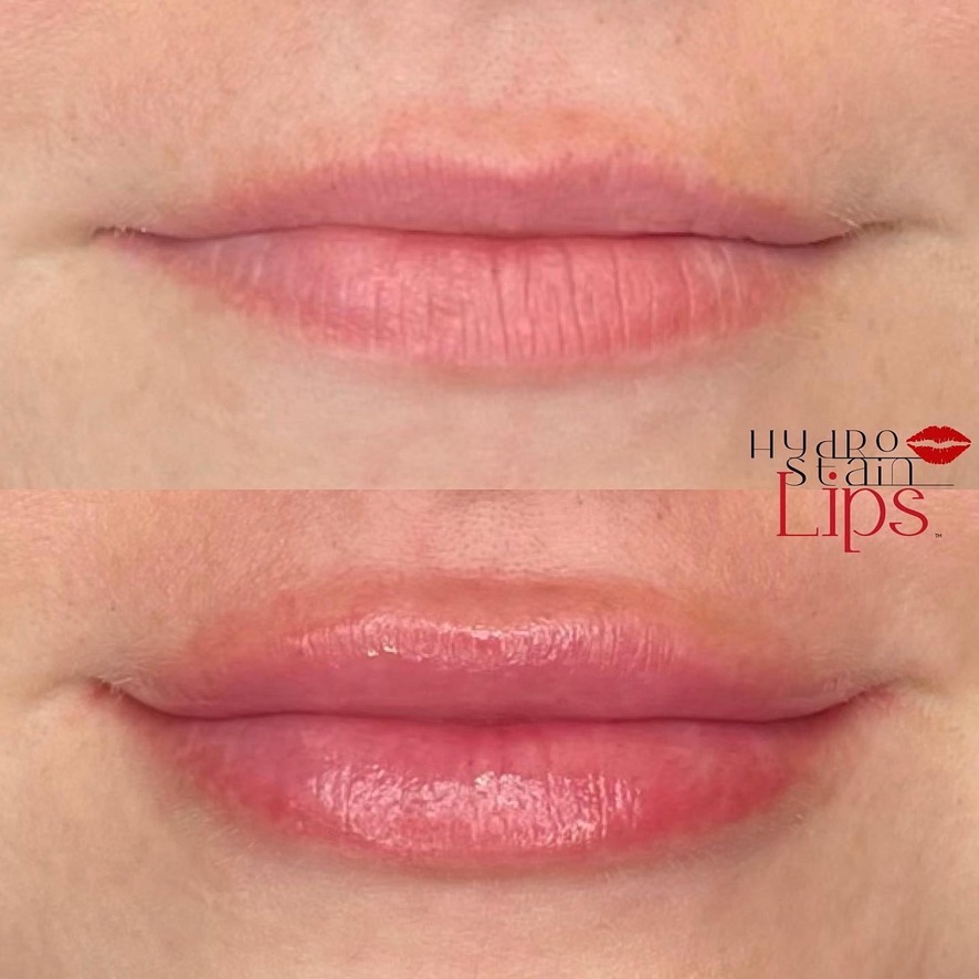 HydroStain Lips™ Before and After