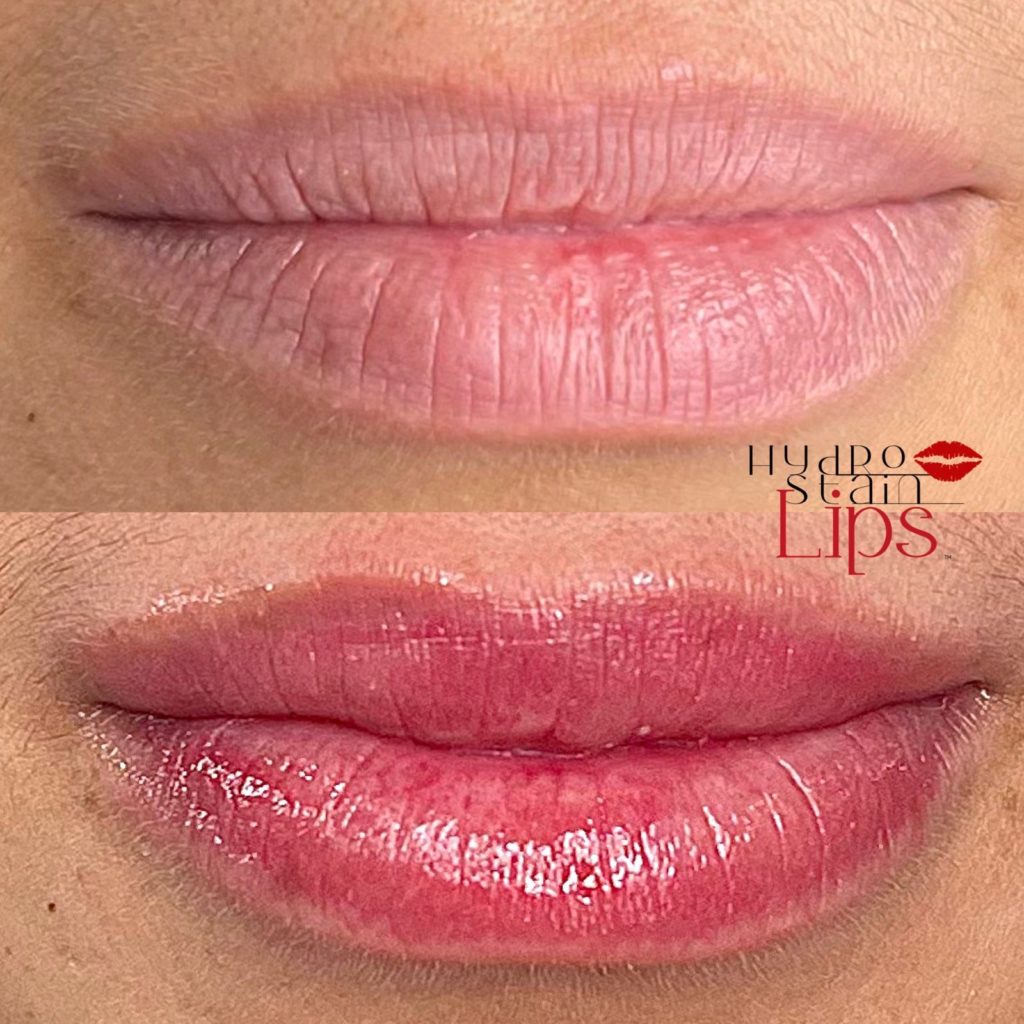 HydroStain Lips™ Before and After